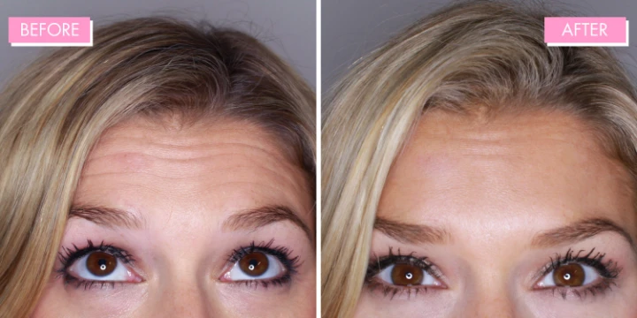 20 Units of Botox Before and After