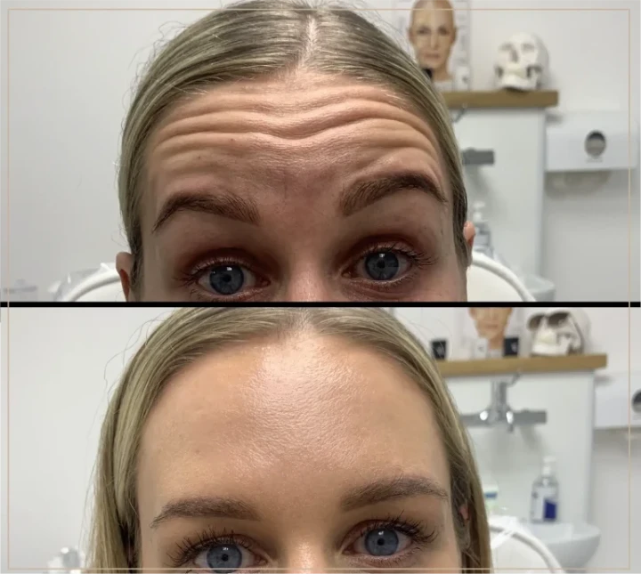 20 Units of Botox Before and After