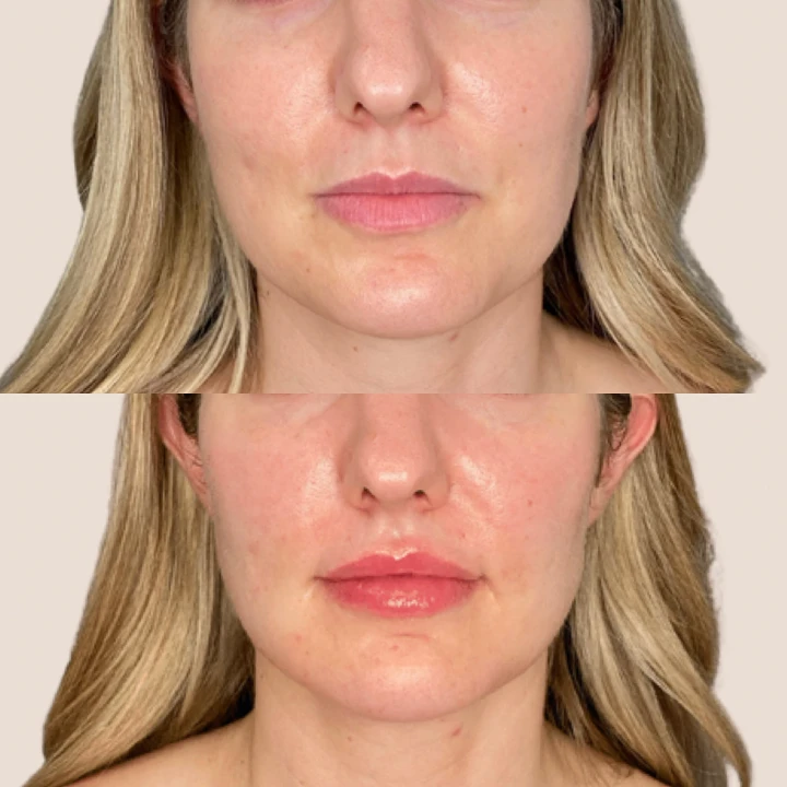 20 Units of Botox Before and After