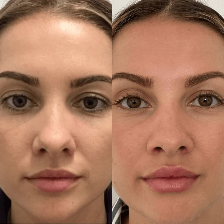 20 Units of Botox Before and After