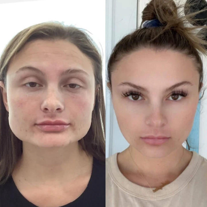 20 Units of Botox Before and After