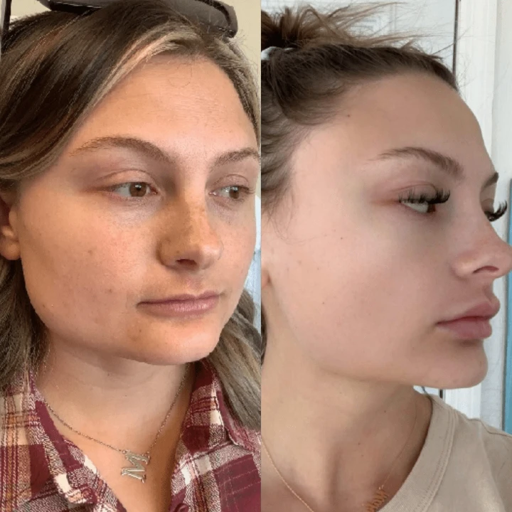 20 Units of Botox Before and After