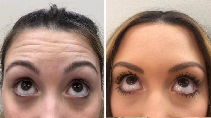 20 Units of Botox Before and After