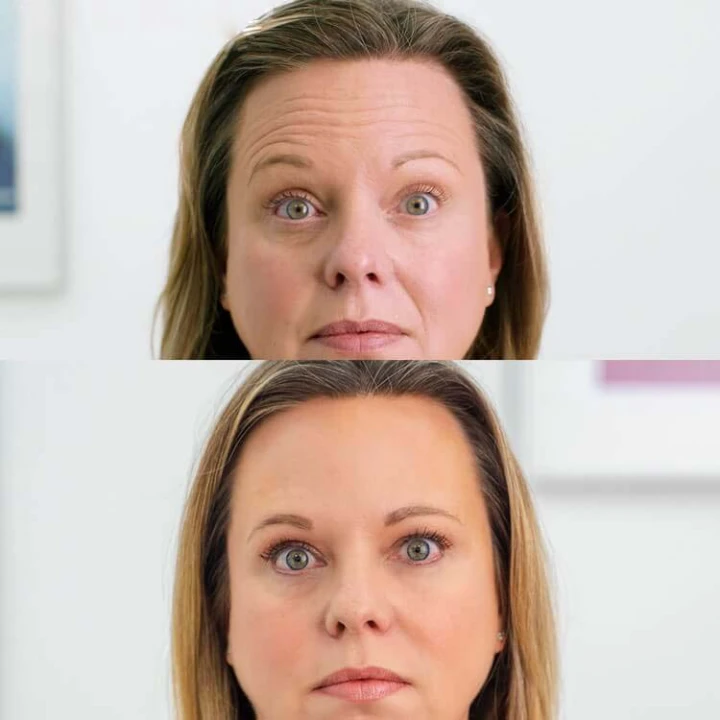 20 Units of Botox Before and After