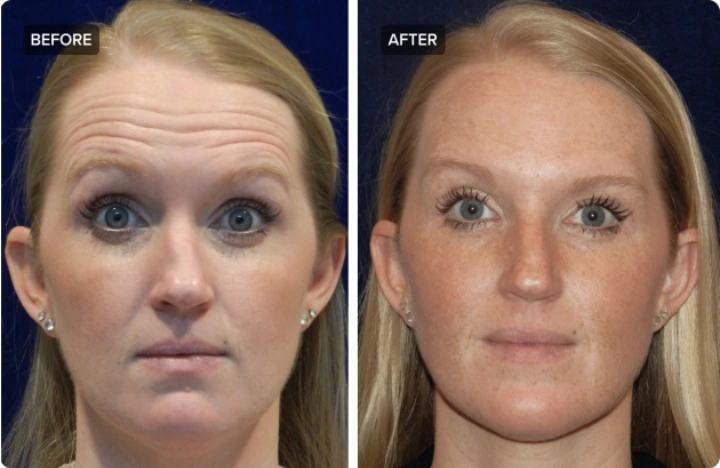 40 Units of Botox Before and After