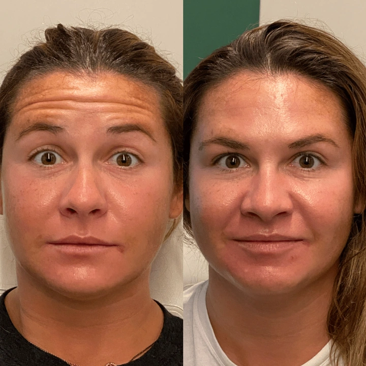 40 Units of Botox Before and After