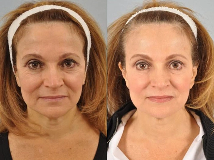 40 Units of Botox Before and After