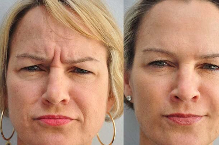 40 Units of Botox Before and After