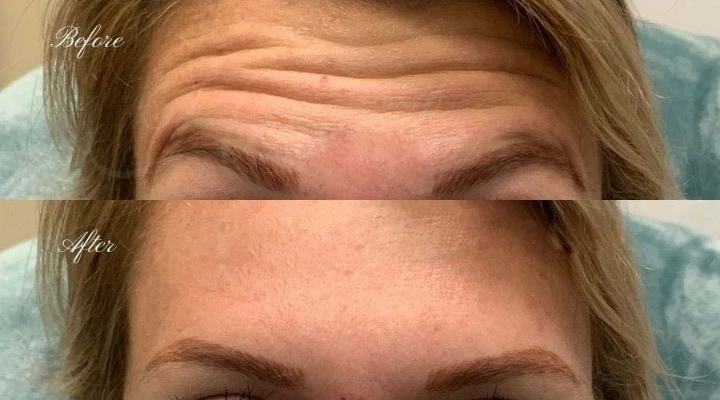 40 Units of Botox Before and After