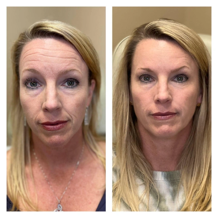 40 Units of Botox Before and After