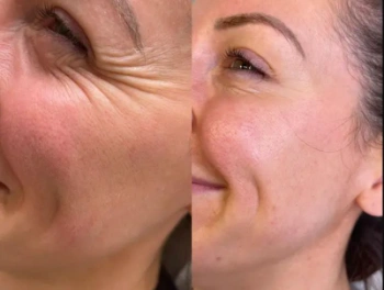 40 units of botox before and after