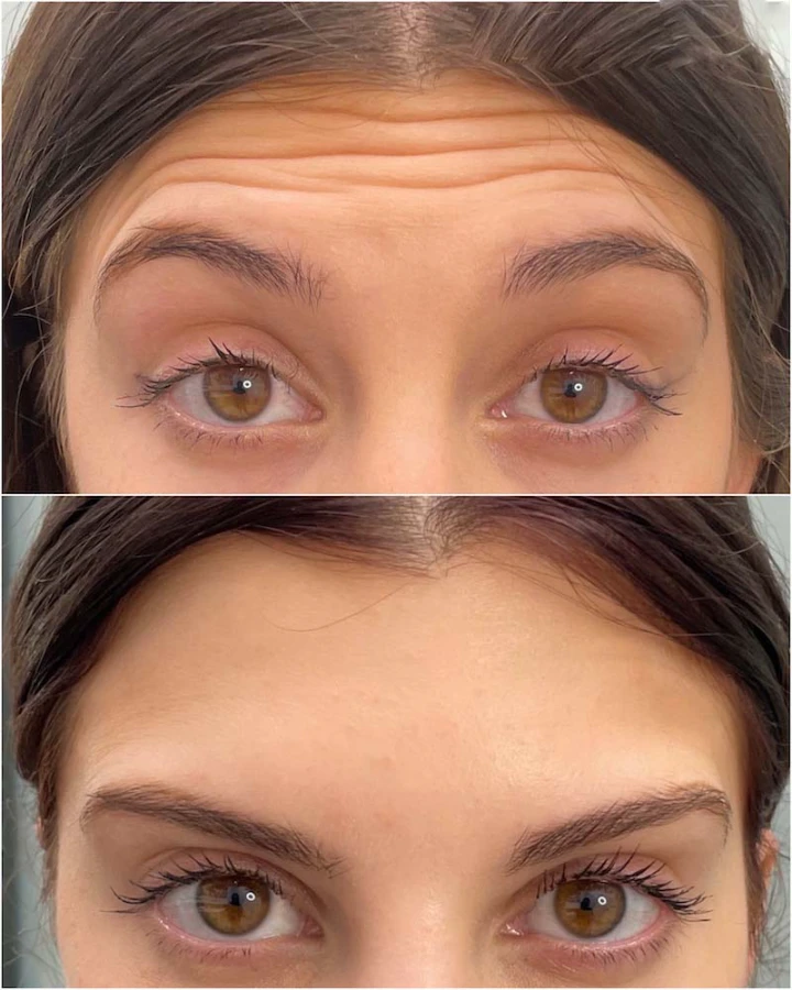 Botox Forehead Before and After