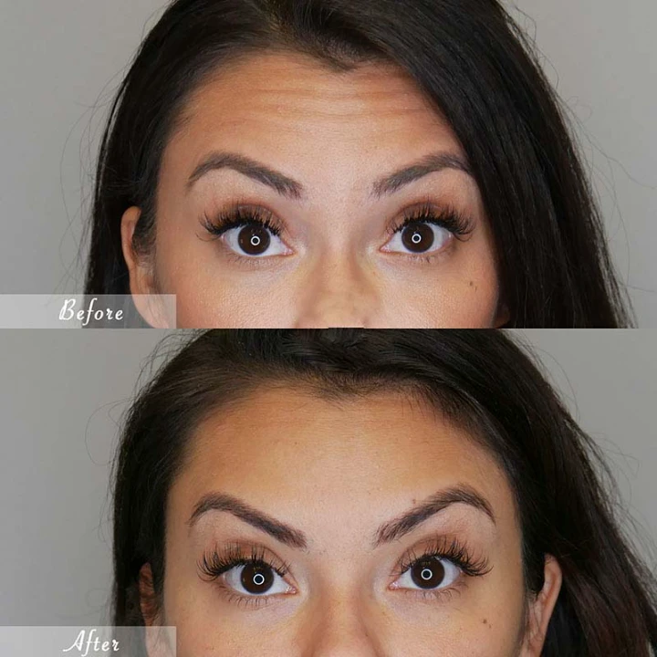 Botox Forehead Lift Before and After