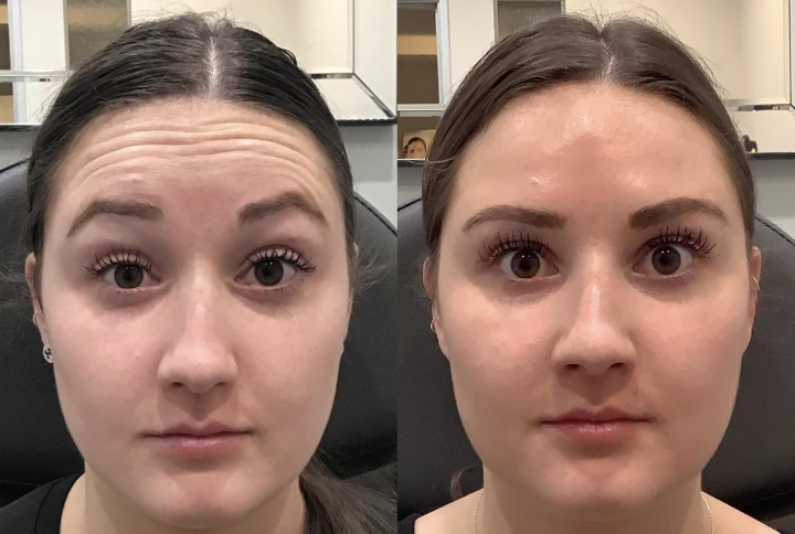 Botox Forehead Lift Before and After