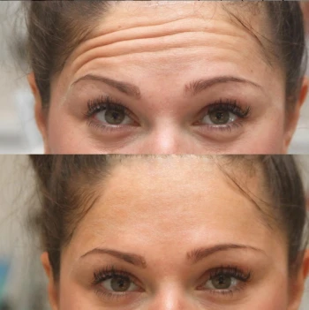 Botox Forehead Lift Before and After