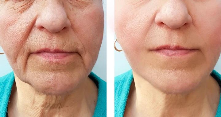 Botox Marionette Lines Before and After