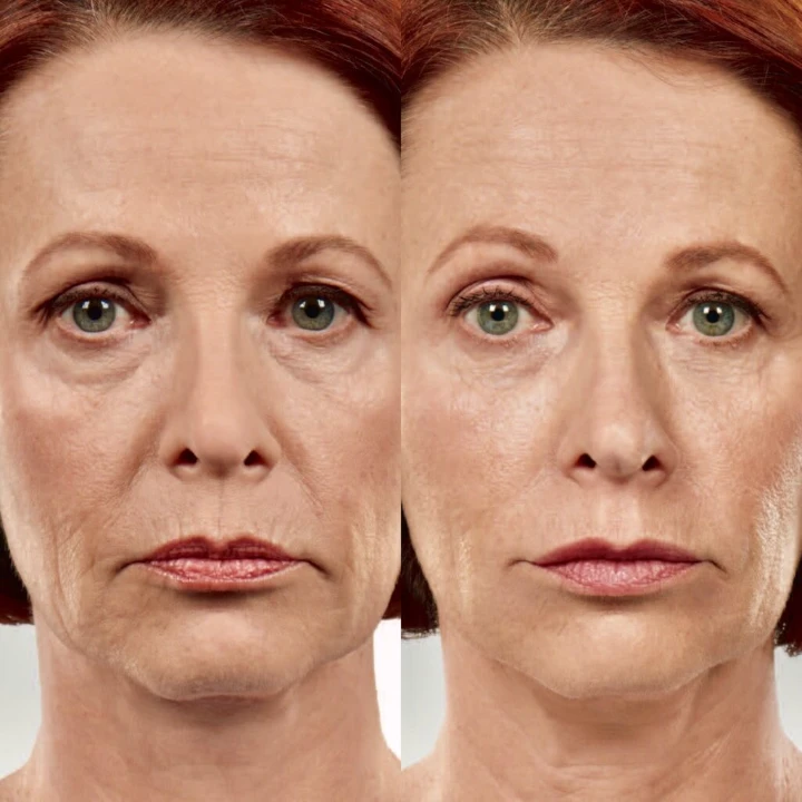 Botox Marionette Lines Before and After