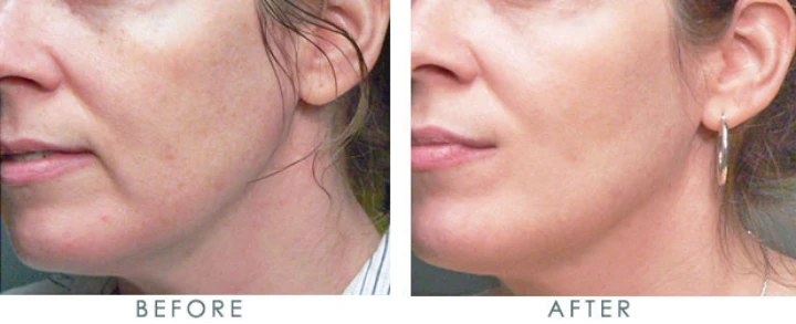 Botox Marionette Lines Before and After