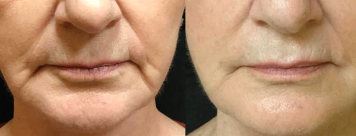 Botox Marionette Lines Before and After