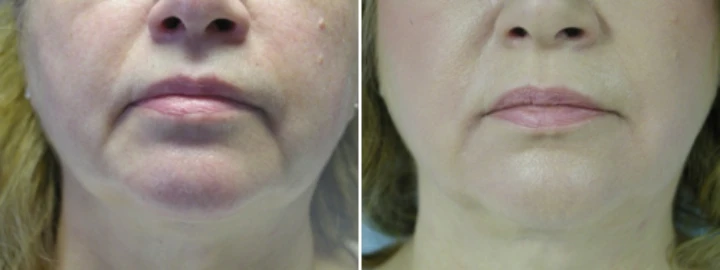 Botox Marionette Lines Before and After