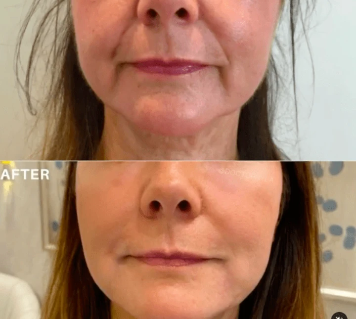 Botox Marionette Lines Before and After