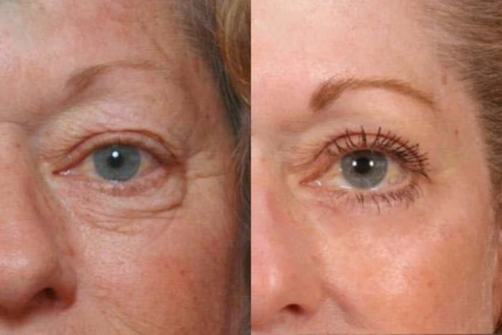 Botox Under Eye Bags Before After