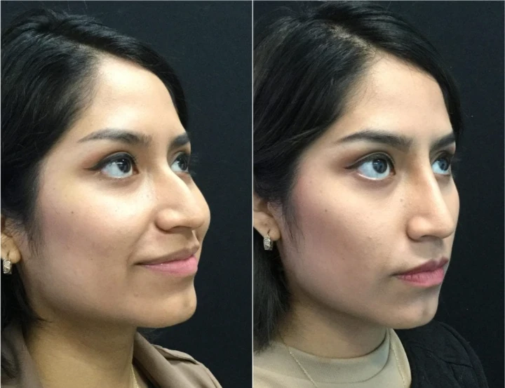 Botox for Nose Slimming