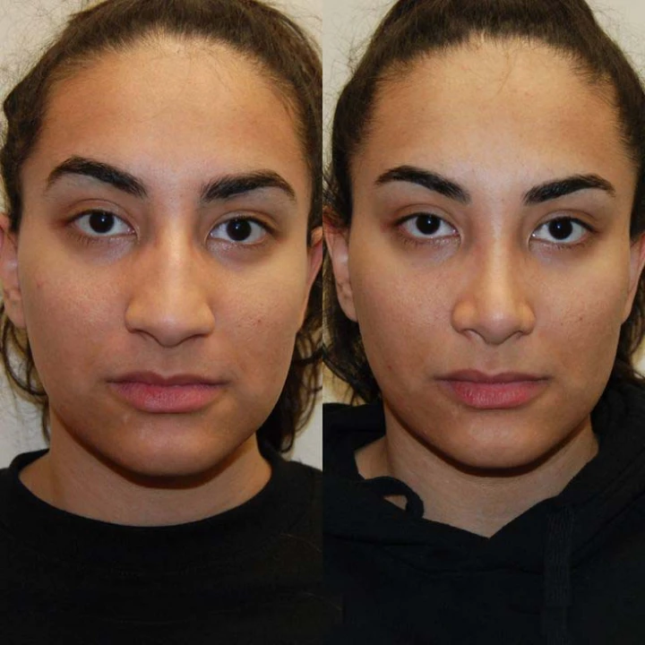 Botox for Nose Slimming Before and After