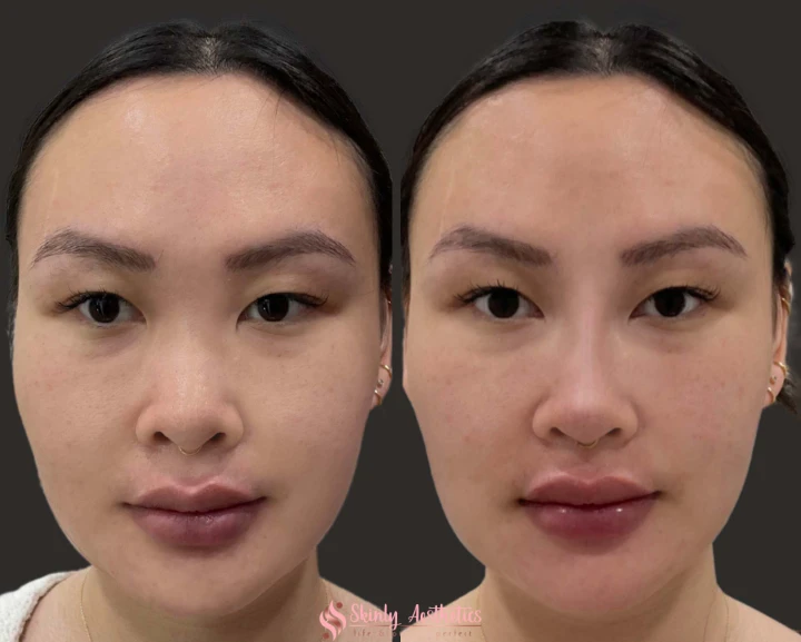 Botox for Slimming Wide Nose