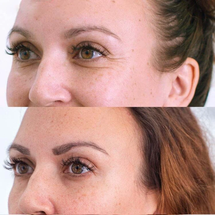 Botox for Under Eye Wrinkles When Smiling