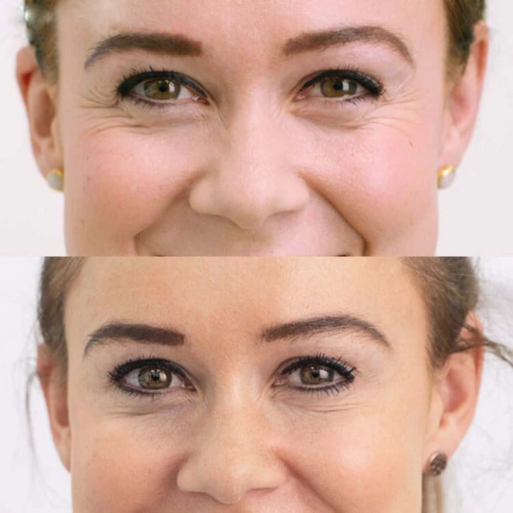 Botox for Under Eye Wrinkles When Smiling