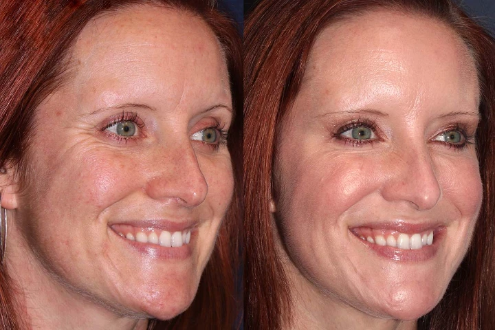 Botox for Under Eye Wrinkles When Smiling