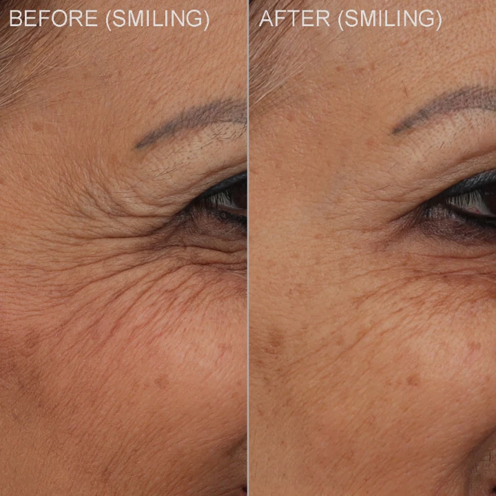 Botox for Under Eye Wrinkles When Smiling