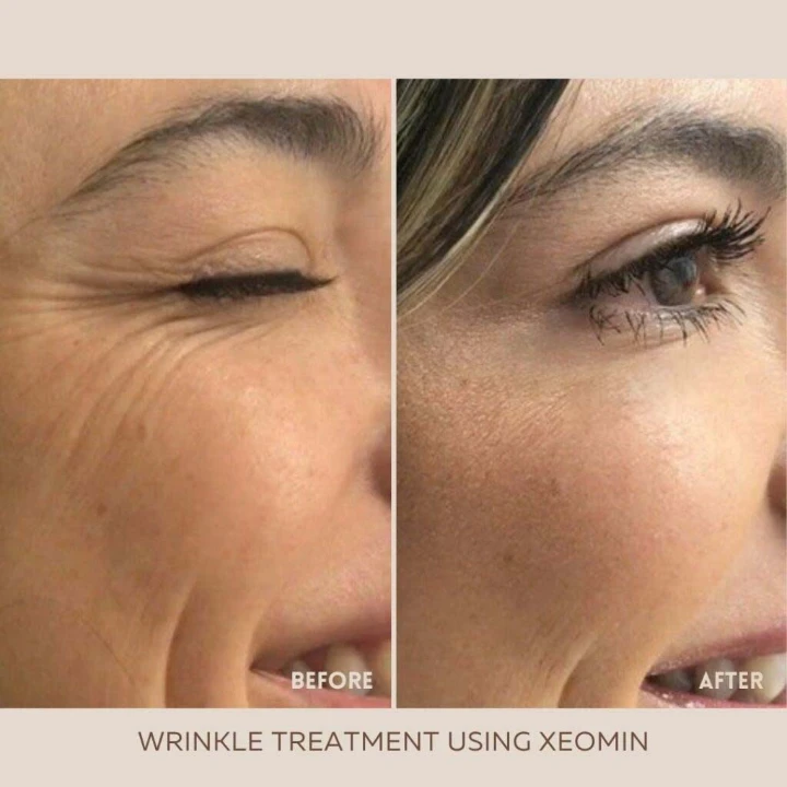 Botox for Under Eye Wrinkles When Smiling