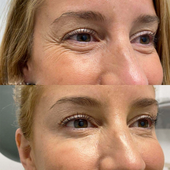 Botox for Under Eye Wrinkles When Smiling