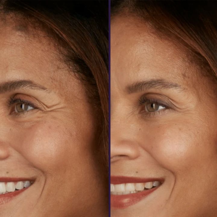 Botox for Under Eye Wrinkles When Smiling