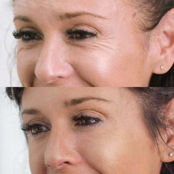 Botox for Under Eye Wrinkles When Smiling