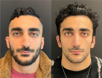 Botox on Men before and after