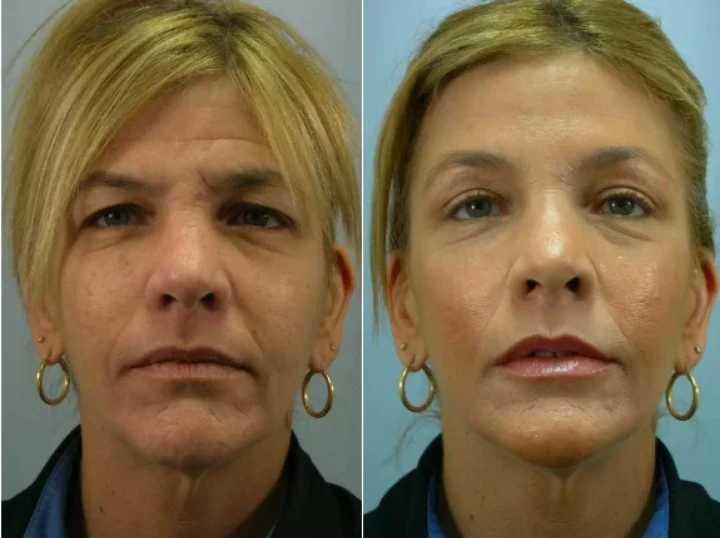 Botox to Lift Eyebrows