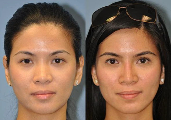 Botox to Make Nose Smaller