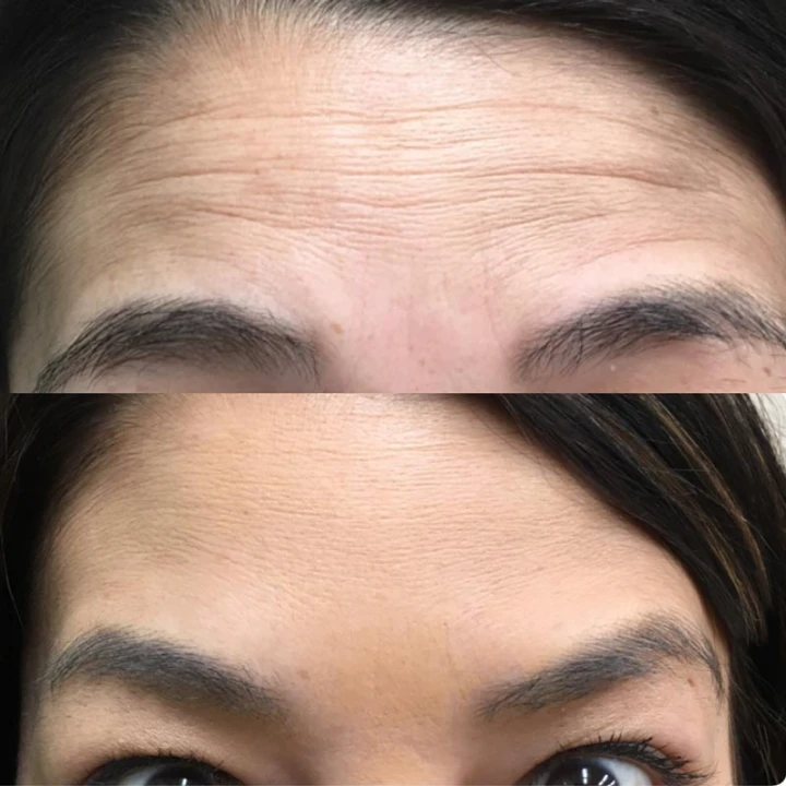 Brow Lift Before and After