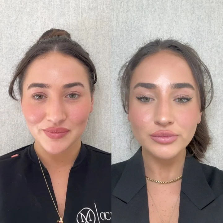 Chin Botox Before and After