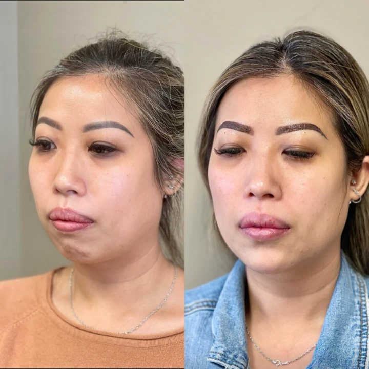 Chin-Botox before and after