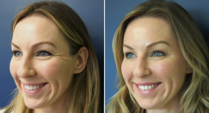 Crows Feet Before and After Botox