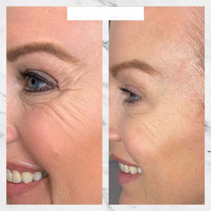 Crows Feet Before and After Botox