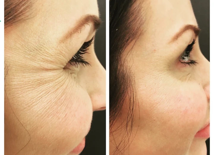 Crows Feet Before and After Botox