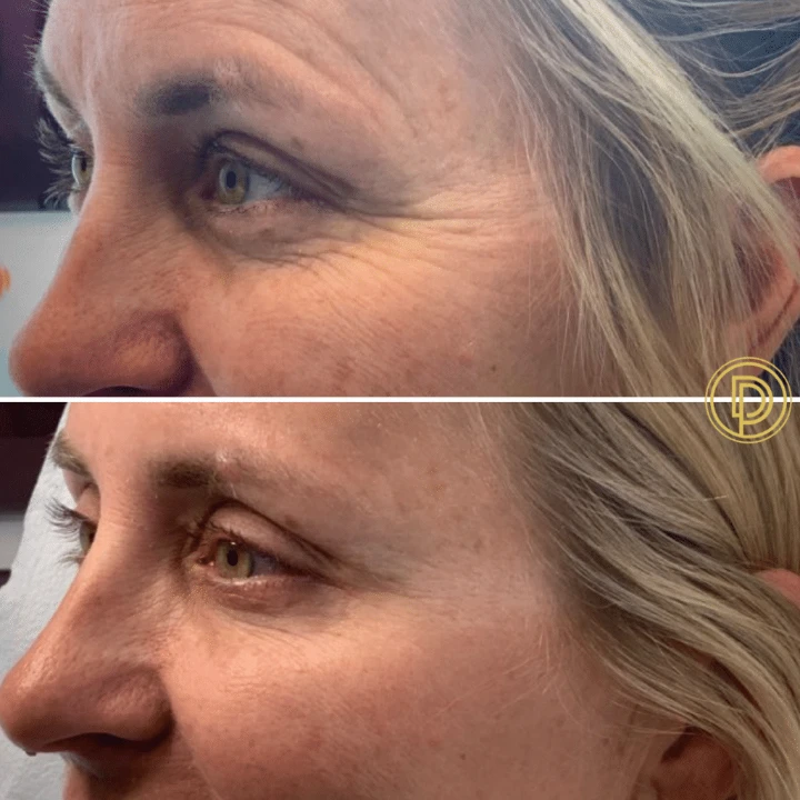 Crows Feet Before and After Botox