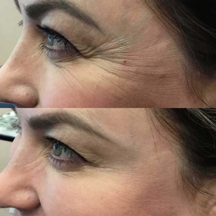 Crows Feet Before and After Botox