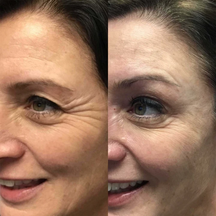 Crows Feet Before and After Botox