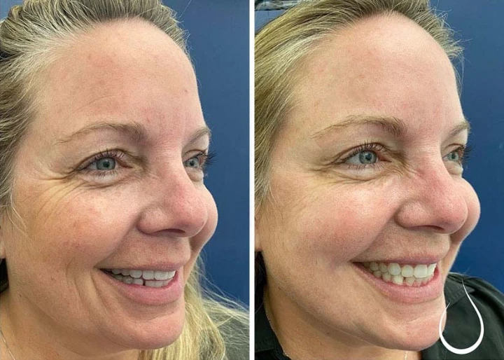 Crows Feet Before and After Botox